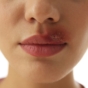 Close-up of a Woman with herpes on lip.