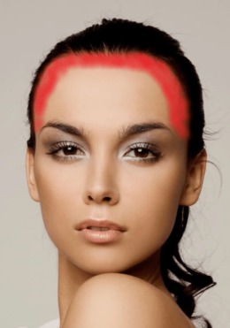 acne hairline map