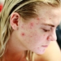 adult woman with acne