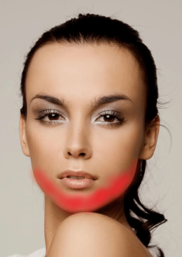 acne jawline map