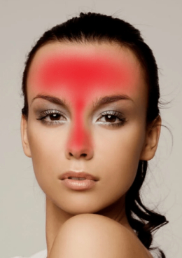 acne t-zone map