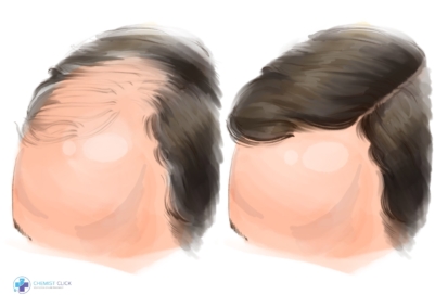 finasteride before and after