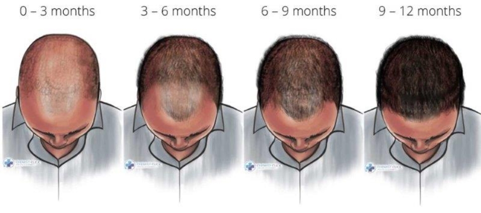 finasteride results infographic