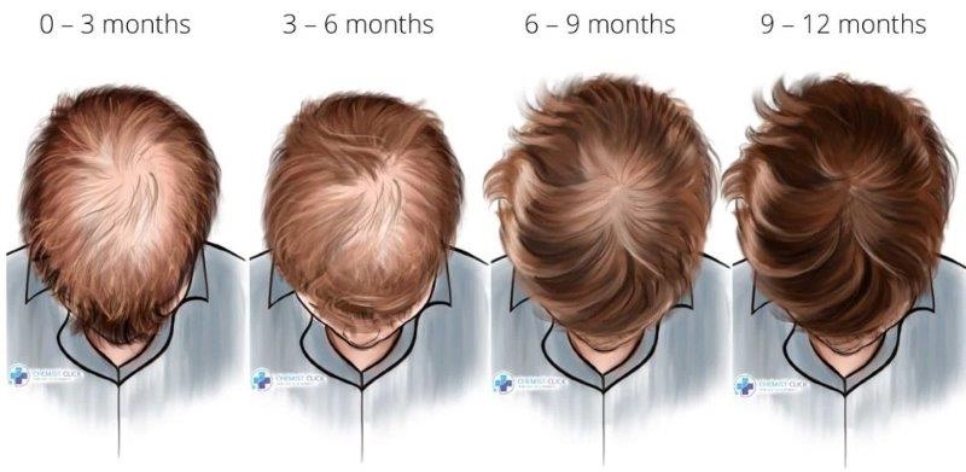 finasteride results infographic