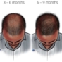 finasteride results timeline infographic
