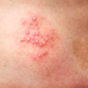 herpes rash