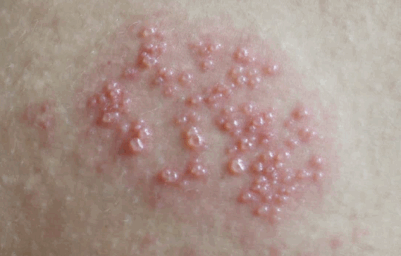 herpes sores on skin