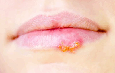 mouth herpes sore