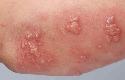 herpes sores