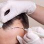 medical professional prepares man for hair transplant