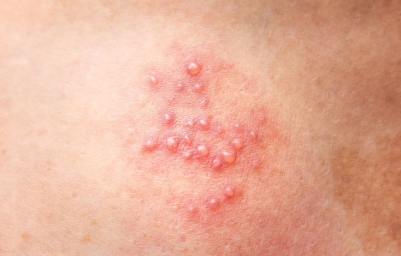 herpes rash sores