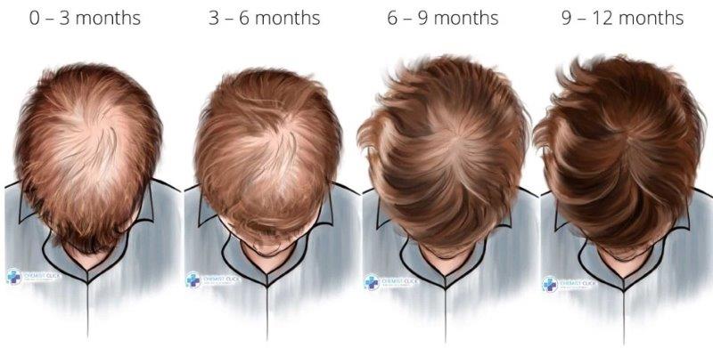 Finasteride Results Timeline (with pictures)