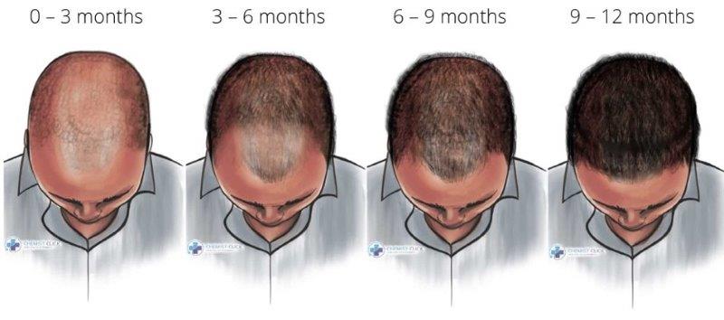 finasteride one year results Afro hair