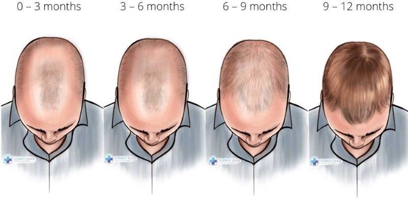 Timeline of finasteride results after 1 year