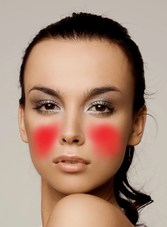 A picture of a woman's cheeks showing where acne can develop around the cheeks