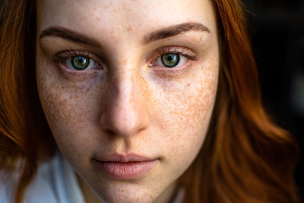 Picture of a girl's face after finding out about the different types of face & body acne.