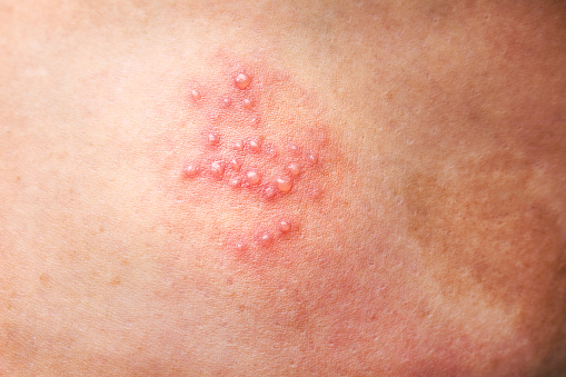 Herpes rash picture