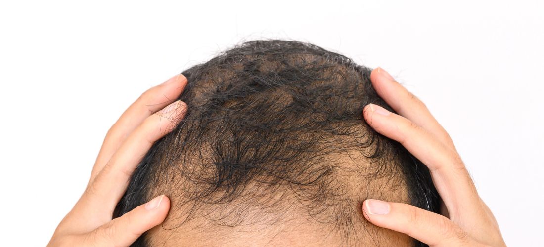 Balding man holding and scratching his head