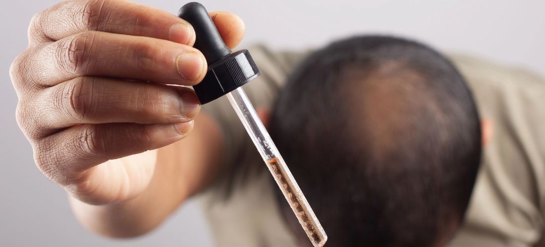 Man applying pipette to hair loss
