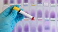 Chlamydia Test Kit