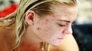 close-up of woman's acne on her face