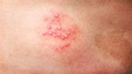 herpes rash picture