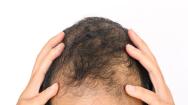 Balding man holding and scratching his head