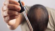 Man applying pipette to hair loss