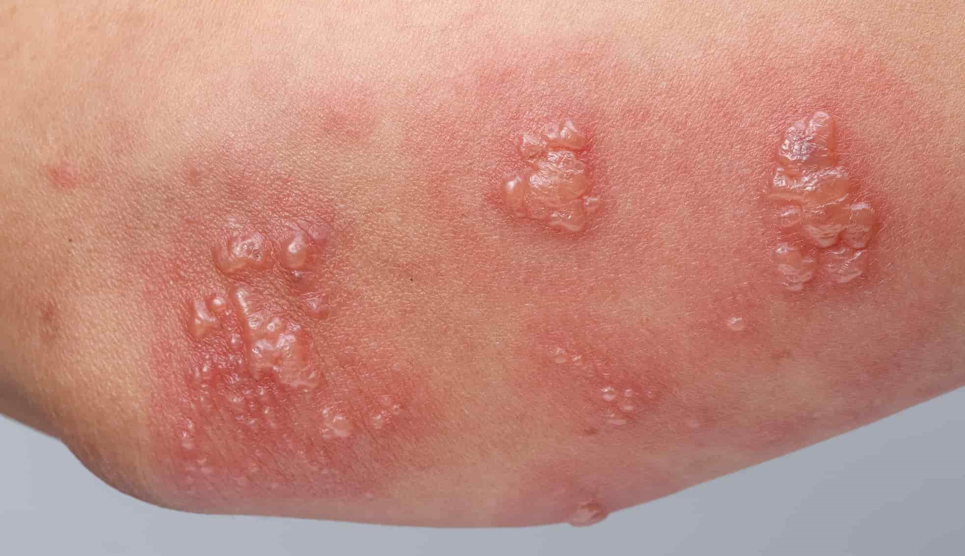 Kalemba - #ELPAS MEDCARE: Ring worms Ringworm is a common skin infection  that is caused by a fungus. It's called “ringworm” because of its common  tendency to cause a circular like rash (