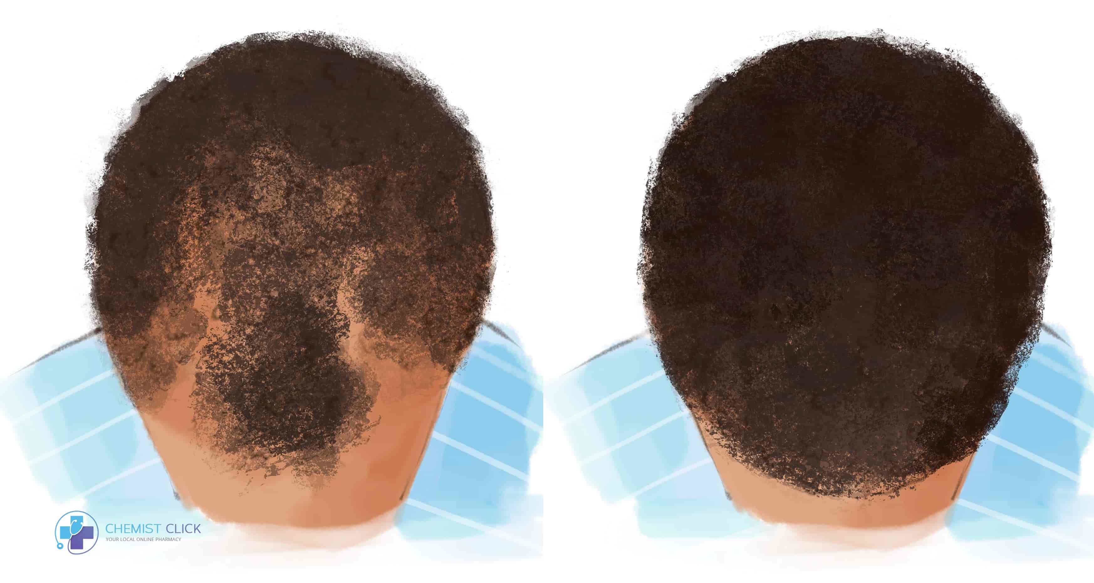 Afro hair before and after with finasteride