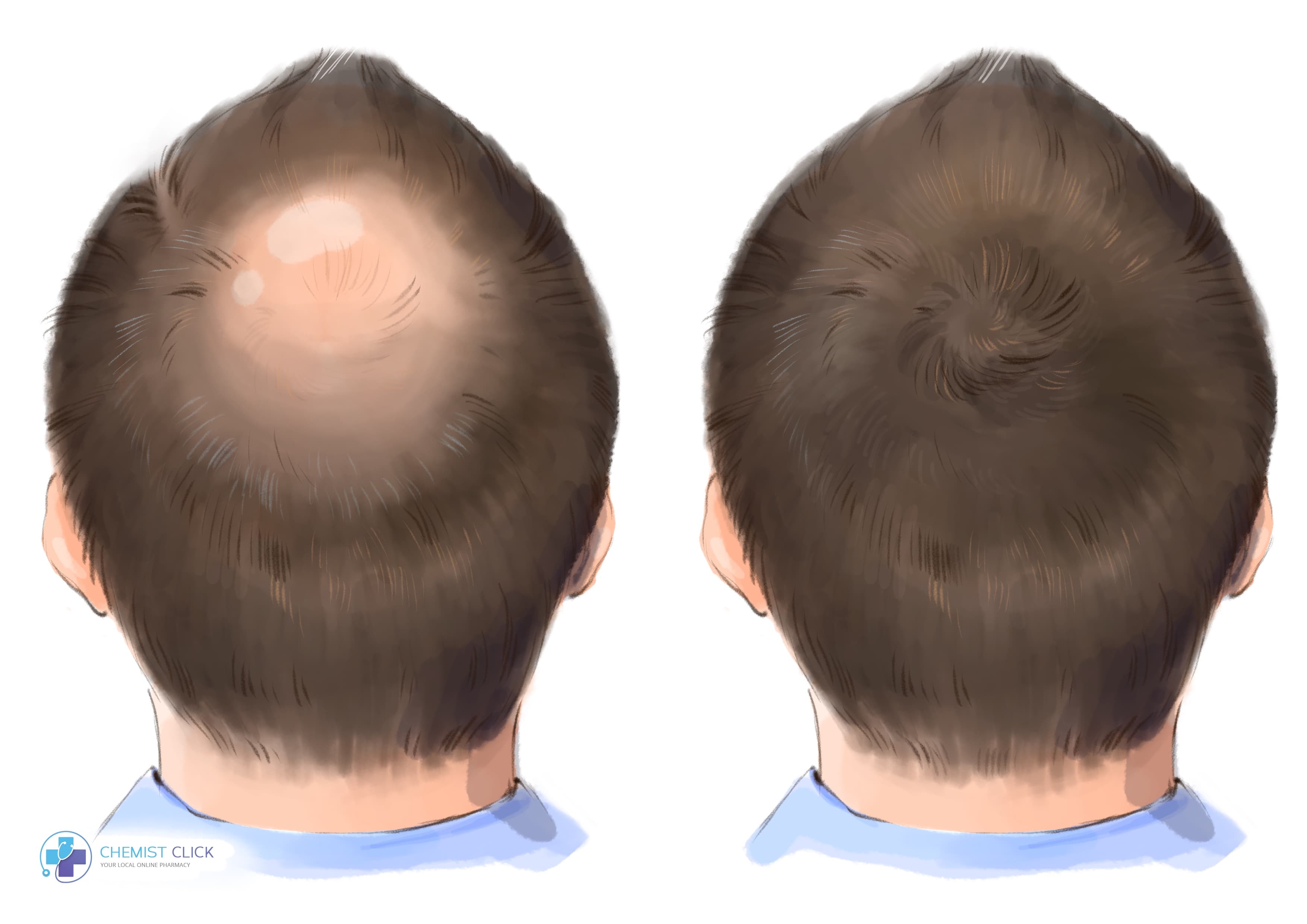 balding at the crown before and after picture with using finasteride