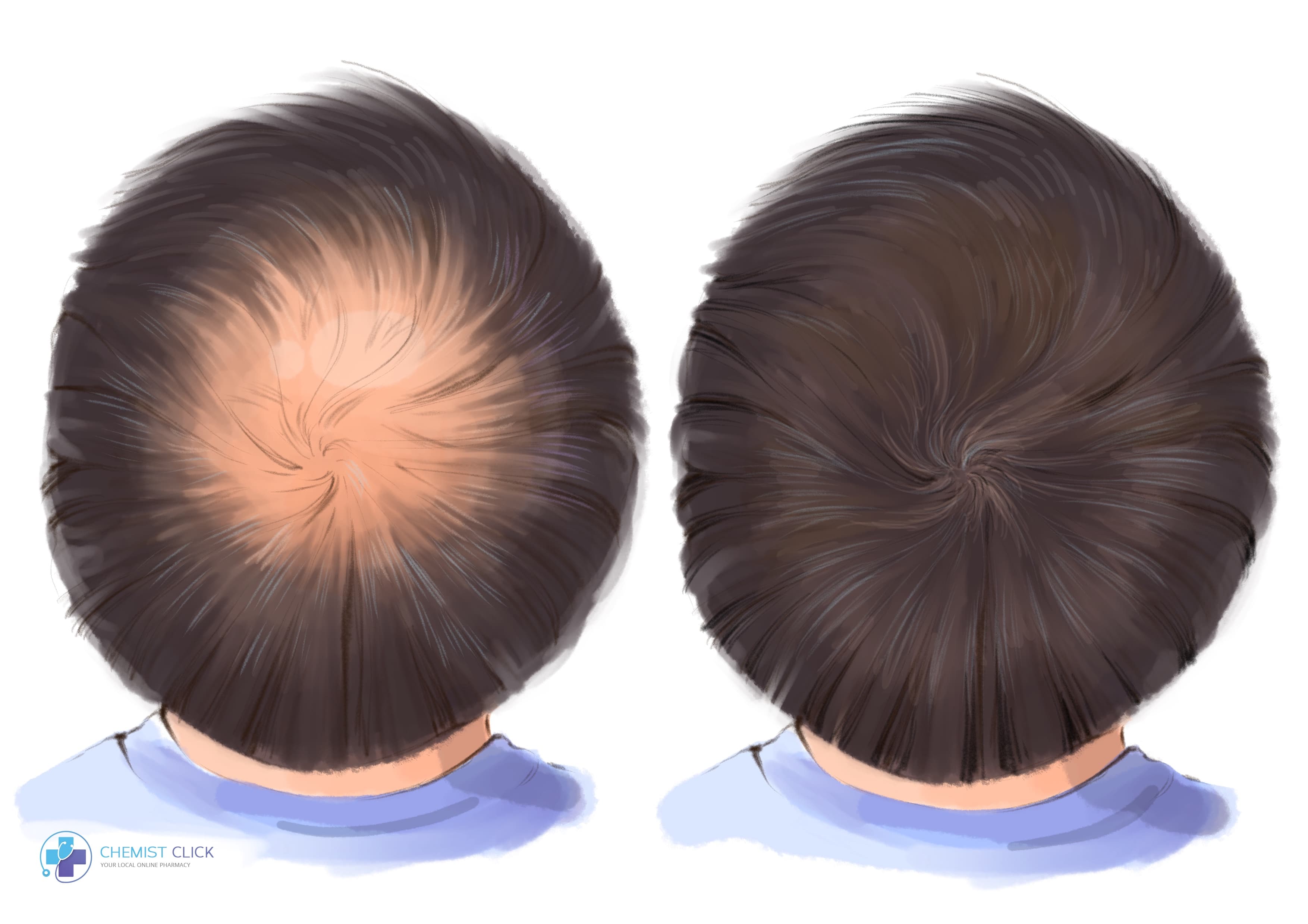 finasteride Propecia results before and after picture
