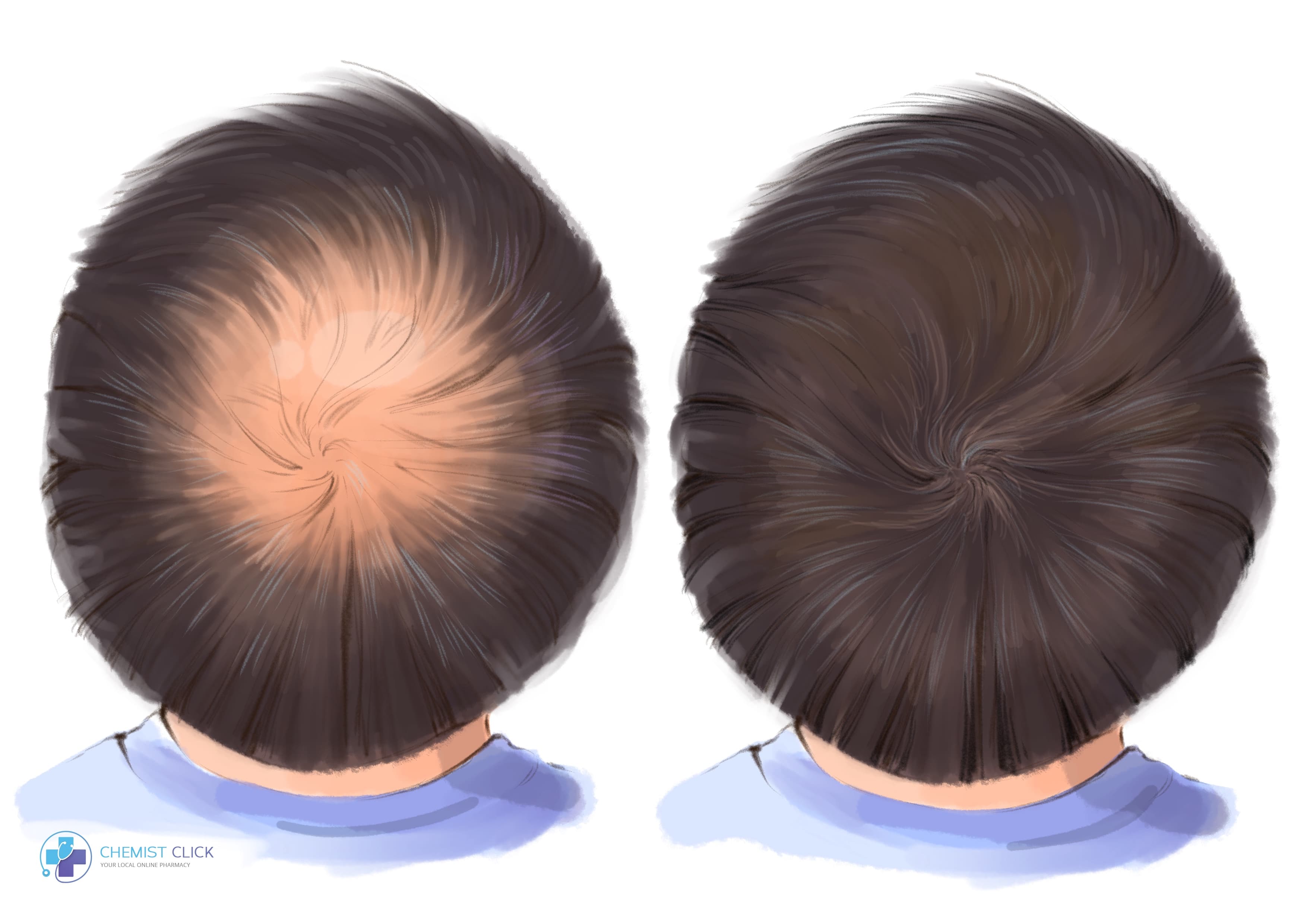 Finasteride: Before and After (with pictures)