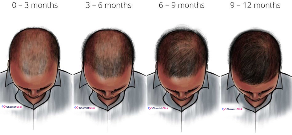 Understanding Finasteride: Results Timeline and How Long It Takes to Work